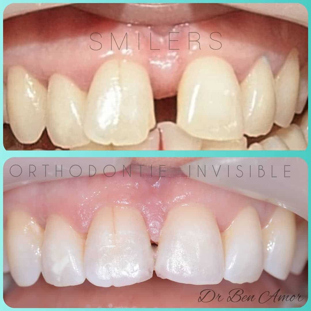 découvrez la gouttière invisible, une solution orthodontique discrète et efficace pour redresser vos dents sans appareil traditionnel. offrez-vous un sourire parfait tout en préservant votre esthétique.
